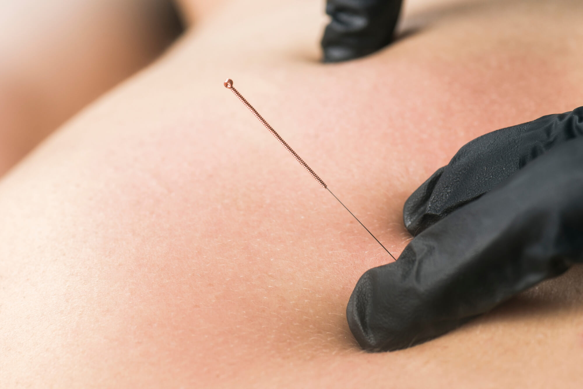 Dry Needling in Racine